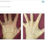 BBL Laser: Before and After photo of hands