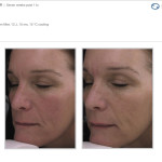 BBL Laser: Before and After photo of face