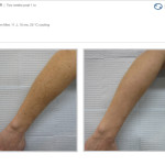 BBL Laser: Before and After photo of arms