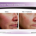 Excel V Laser: Before and After photo of redness