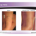 Excel V Laser: Before and After photo of Leg Veins