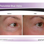 Excel V Laser: Before and After photo of Periorbital Veins