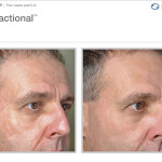 Profractional Laser Before and After of Face