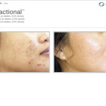 Profractional Laser Before and After of face