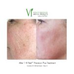 ViPeel Before and After, Redness and Freckles