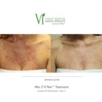 ViPeel Before and After, Spots on Chest