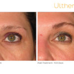 Ultherapy Before and After Crows Feet