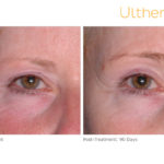 Ultherapy Before and After Eyes