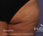 truSculpt Before and After