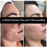 ViPeel Precision Plus and Microneedling Berfore and After