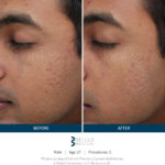 PRP Skin Pen Microneedling Before and After Face