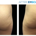 Emsculpt Before and After Glutes