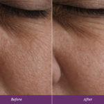 Allumera Before and After