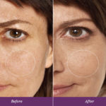 Allumera Before and After