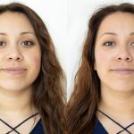 Hydrafacial Before and After acne Redness