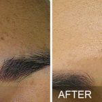 Hydrafacial - before after Brown Spots