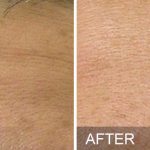 Hydrafacial - before and after Fine Lines