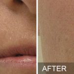 Hydrafacial - before and after Nasolabial Folds