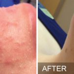 Hydrafacial - before and after oily acne congested skin