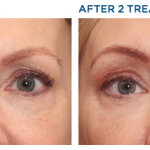 Exilis Before and After eye area