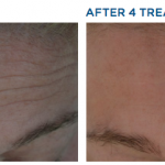 Exilis Before and After Forehead Lines