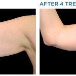 Exilis Before and After Upper Arm Improvement
