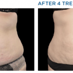 Exilis Before and After Waistline Improvement