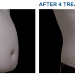 Exilis Before and After Wastline Improvement