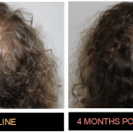 Keravive Before and After: Hairgrowth