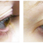 Tixel Before and After Eyes