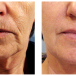 Tixel Before and After Lower Face