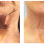 Tixel Before and After Neck